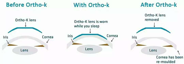 小兒眼病,?，斎鹨曆劭?上海眼科醫(yī)院