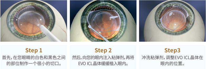 屈光矯視,?，斎鹨曆劭?上海眼科醫(yī)院