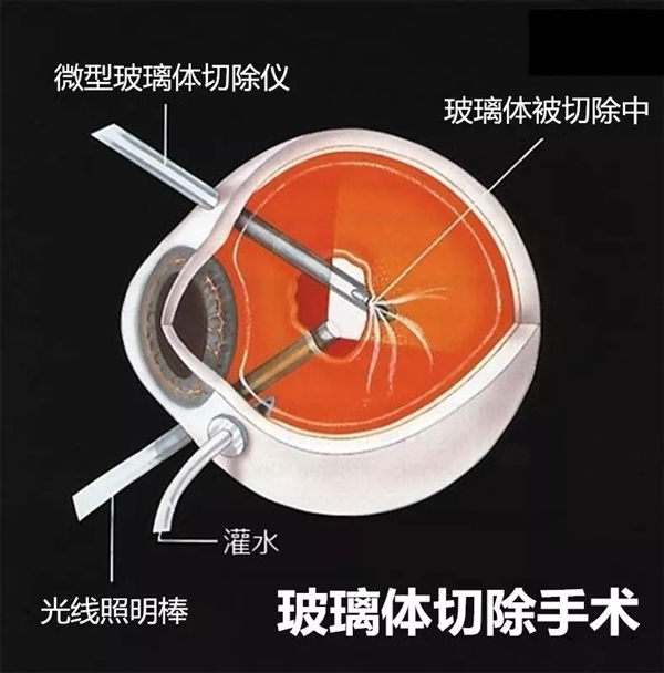 玻璃體視網(wǎng)膜,?，斎鹨曆劭?上海眼科醫(yī)院