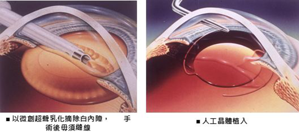 青光眼,希瑪瑞視眼科,上海眼科醫(yī)院