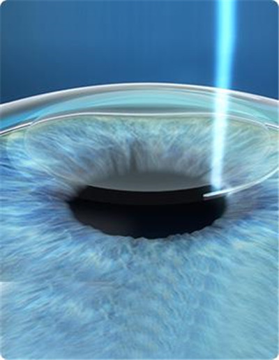 屈光矯視,?，斎鹨曆劭?上海眼科醫(yī)院