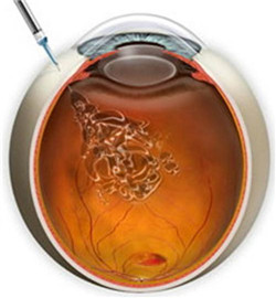 玻璃體視網(wǎng)膜,?，斎鹨曆劭?上海眼科醫(yī)院