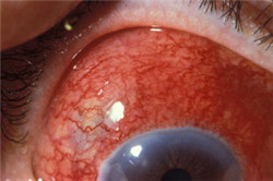 眼表眼角膜,?，斎鹨曆劭?上海眼科醫(yī)院