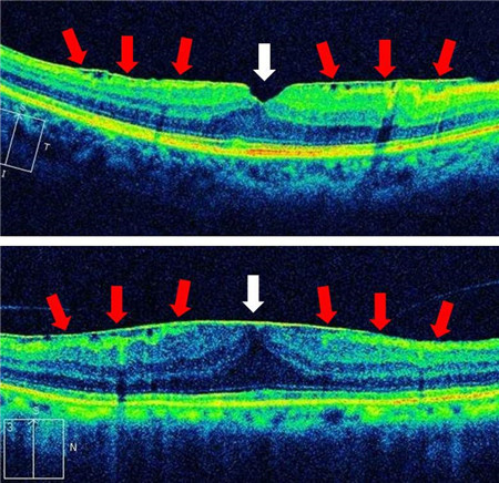 玻璃體視網(wǎng)膜,?，斎鹨曆劭?上海眼科醫(yī)院