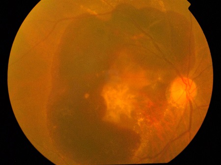 玻璃體視網(wǎng)膜,?，斎鹨曆劭?上海眼科醫(yī)院