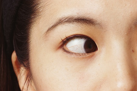 小兒眼病,?，斎鹨曆劭?上海眼科醫(yī)院