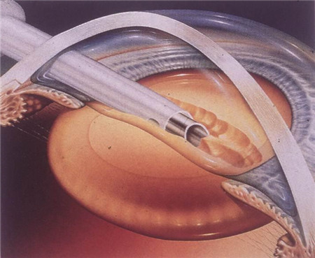 青光眼,?，斎鹨曆劭?上海眼科醫(yī)院