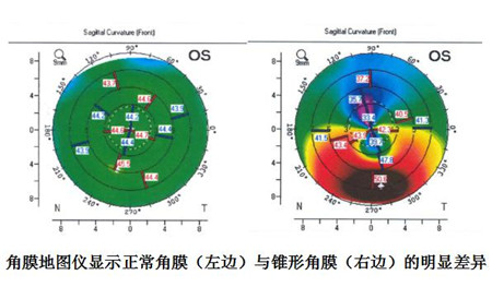 眼表眼角膜,?，斎鹨曆劭?上海眼科醫(yī)院