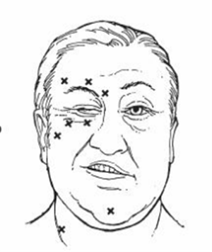 眼眶病,?，斎鹨曆劭?上海眼科醫(yī)院