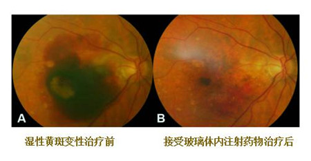 玻璃體視網(wǎng)膜,?，斎鹨曆劭?上海眼科醫(yī)院
