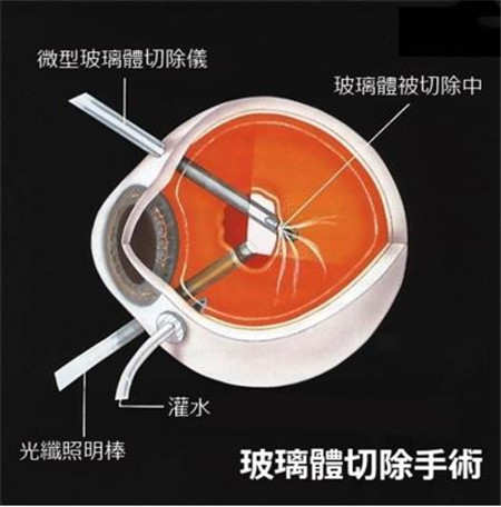 玻璃體視網(wǎng)膜,?，斎鹨曆劭?上海眼科醫(yī)院