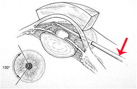 青光眼,?，斎鹨曆劭?上海眼科醫(yī)院