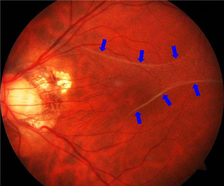 玻璃體視網(wǎng)膜,?，斎鹨曆劭?上海眼科醫(yī)院
