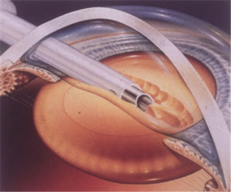 白內(nèi)障,希瑪瑞視眼科,上海眼科醫(yī)院