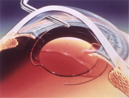 白內(nèi)障,?，斎鹨曆劭?上海眼科醫(yī)院