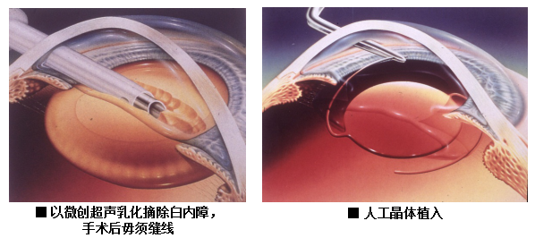 白內(nèi)障,?，斎鹨曆劭?上海眼科醫(yī)院