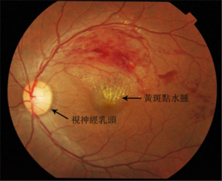 玻璃體視網(wǎng)膜,?，斎鹨曆劭?上海眼科醫(yī)院