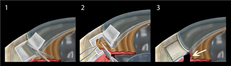青光眼,?，斎鹨曆劭?上海眼科醫(yī)院