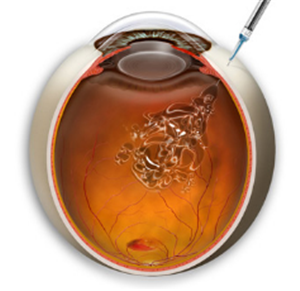 玻璃體視網(wǎng)膜,希瑪瑞視眼科,上海眼科醫(yī)院