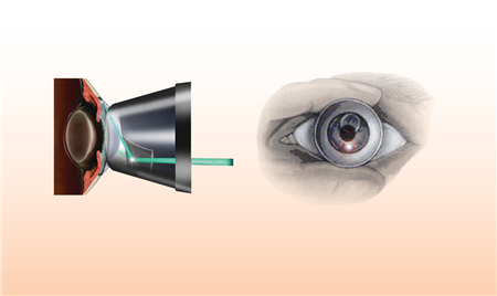 青光眼,?，斎鹨曆劭?上海眼科醫(yī)院