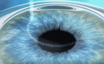 屈光矯視,?，斎鹨曆劭?上海眼科醫(yī)院