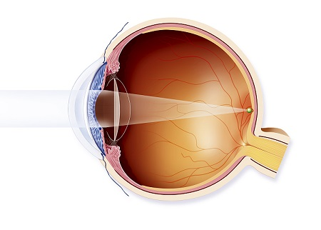 白內(nèi)障,?，斎鹨曆劭?上海眼科醫(yī)院