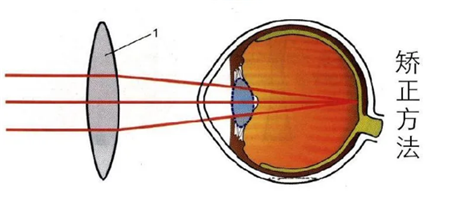 屈光矯視,希瑪瑞視眼科,上海眼科醫(yī)院