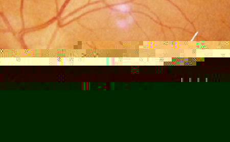 玻璃體視網(wǎng)膜,希瑪瑞視眼科,上海眼科醫(yī)院