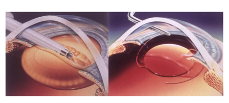 白內(nèi)障,?，斎鹨曆劭?上海眼科醫(yī)院