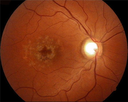 玻璃體視網(wǎng)膜,?，斎鹨曆劭?上海眼科醫(yī)院