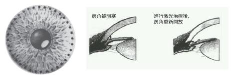 青光眼,?，斎鹨曆劭?上海眼科醫(yī)院