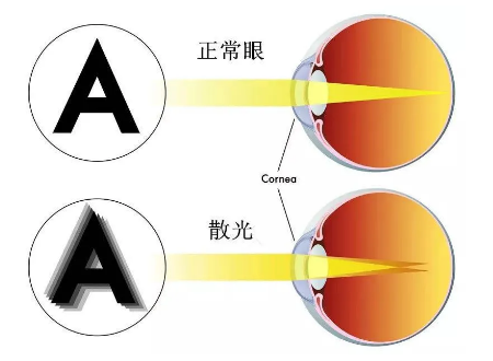 屈光矯視,希瑪瑞視眼科,上海眼科醫(yī)院