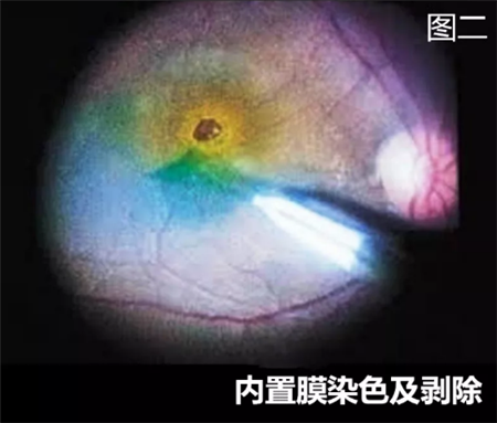 玻璃體視網(wǎng)膜,?，斎鹨曆劭?上海眼科醫(yī)院