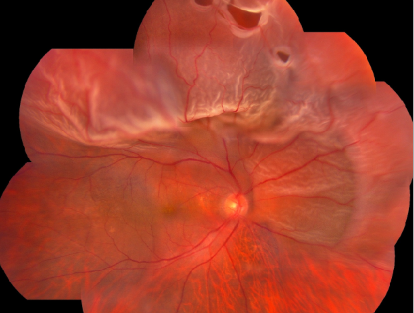 玻璃體視網(wǎng)膜,?，斎鹨曆劭?上海眼科醫(yī)院