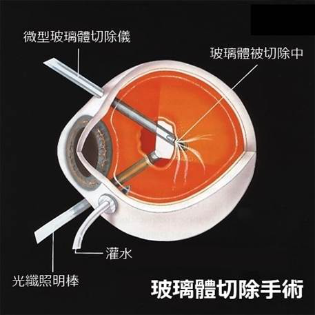 玻璃體視網(wǎng)膜,?，斎鹨曆劭?上海眼科醫(yī)院