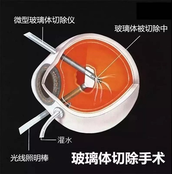 玻璃體視網(wǎng)膜,?，斎鹨曆劭?上海眼科醫(yī)院
