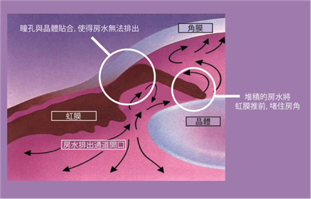 青光眼,?，斎鹨曆劭?上海眼科醫(yī)院