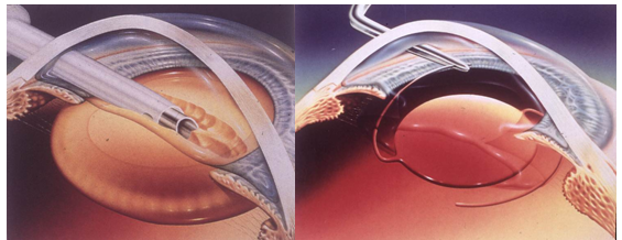 青光眼,?，斎鹨曆劭?上海眼科醫(yī)院