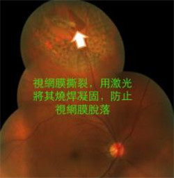 玻璃體視網(wǎng)膜,?，斎鹨曆劭?上海眼科醫(yī)院