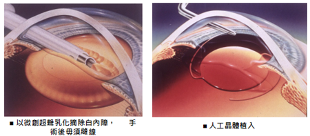 白內(nèi)障,?，斎鹨曆劭?上海眼科醫(yī)院