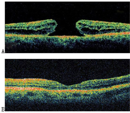 玻璃體視網(wǎng)膜,希瑪瑞視眼科,上海眼科醫(yī)院
