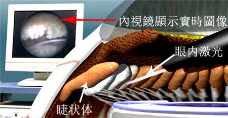 青光眼,希瑪瑞視眼科,上海眼科醫(yī)院