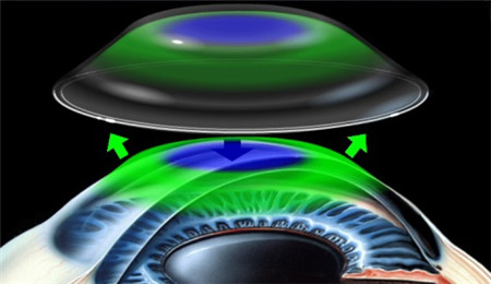 屈光矯視,?，斎鹨曆劭?上海眼科醫(yī)院