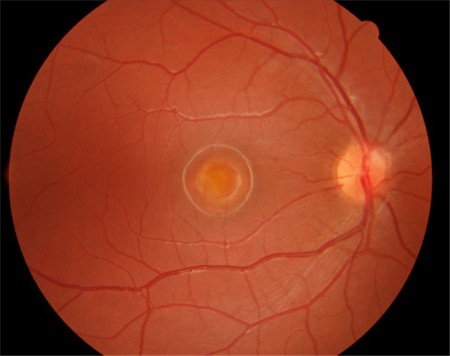 玻璃體視網(wǎng)膜,?，斎鹨曆劭?上海眼科醫(yī)院