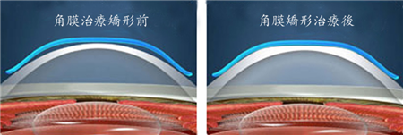 屈光矯視,希瑪瑞視眼科,上海眼科醫(yī)院