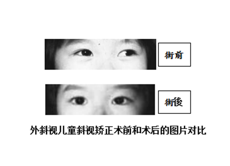 小兒眼病,?，斎鹨曆劭?上海眼科醫(yī)院