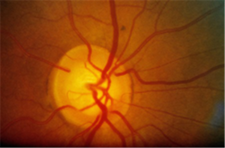 青光眼,?，斎鹨曆劭?上海眼科醫(yī)院