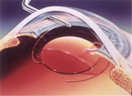 小兒眼病,?，斎鹨曆劭?上海眼科醫(yī)院