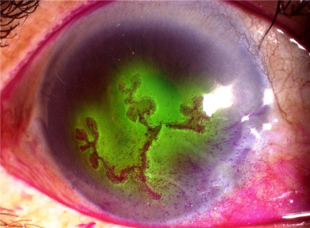 眼表眼角膜,?，斎鹨曆劭?上海眼科醫(yī)院