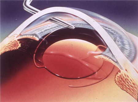 白內(nèi)障,?，斎鹨曆劭?上海眼科醫(yī)院